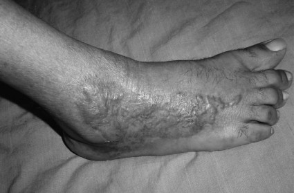 Fig. 5bTangential excision and split-thickness graft done three months follow-up.