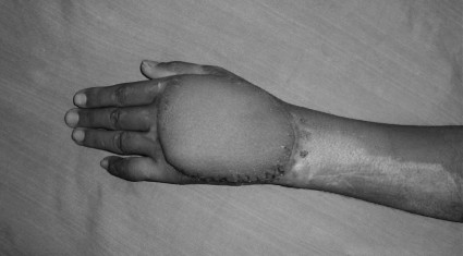 Fig. 6bFull-thickness cover done one month follow-up.