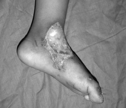 Fig. 7aFriction burn, medial malleolus, foot.