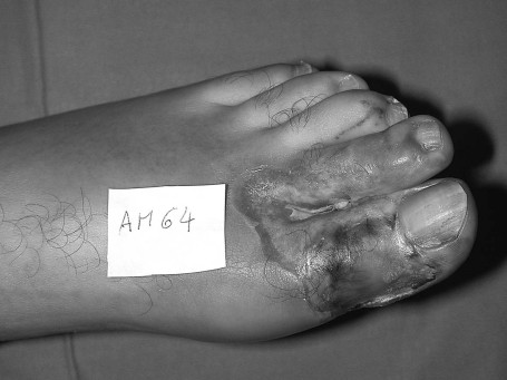 Fig. 1aNecrosis due to electrocution of left hallux.
