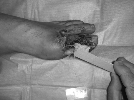 Fig. 1bApplication of 15% salicylate Vaseline.