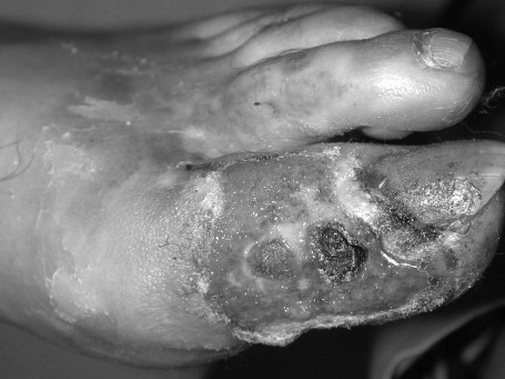 Fig. 1dProgressive wound debridement.