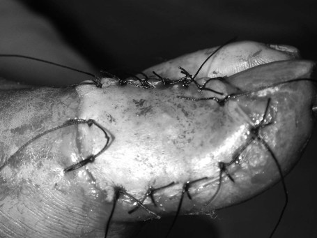 Fig. 1eRepair with skin graft.