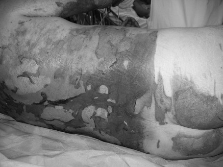 Fig. 2aDeep dermal burn in trunk and buttocks.