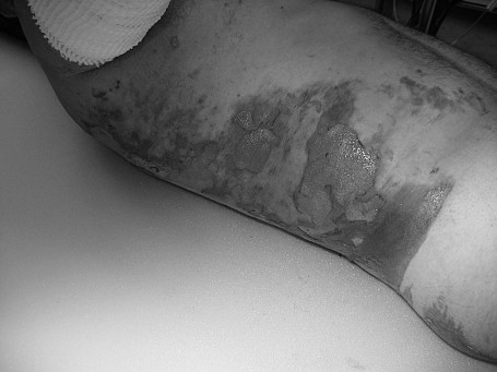 Fig. 2bDecubitus on white Ligasano mattress.