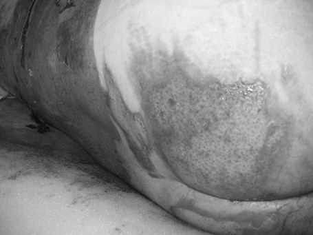 Fig. 2cInitial stage of lesion debridement.