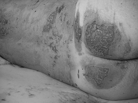 Fig. 2dAdvanced stage of lesion debridement (day 12).
