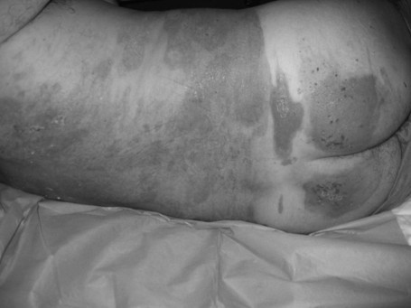 Fig. 2eClinical healing (day 20).