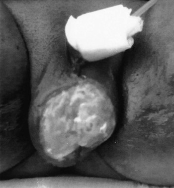 Fig. 1Fournier Gangrene before MEBO local application.