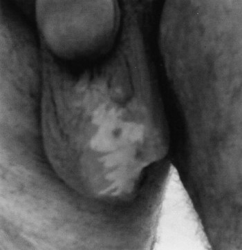Fig. 2Fournier Gangrene after MEBO local application.