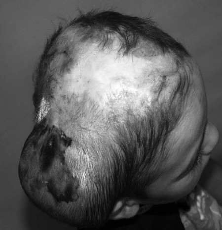 Fig. 2a Traumatic alopecia with 250 ml rectangular expander implanted under the galea.