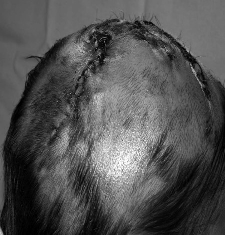 Fig. 2c Excision of alopecic area and spreading of flap.