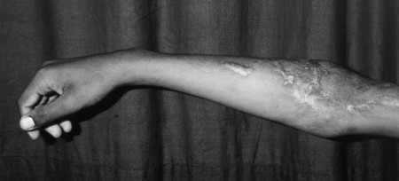 Fig. 3a Severe contraction, graft ulceration, and frequent fissures.