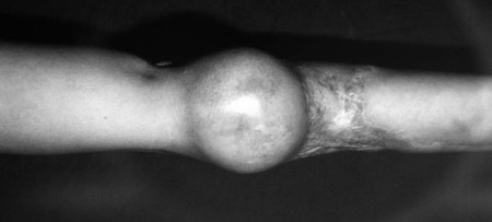 Fig. 3b Placing of circular expander in healthy dorsal area.