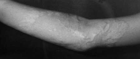 Fig. 3c Six months after spreading of the flap.