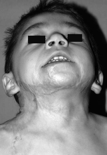 Fig. 4d Reconstruction of neck with another expander.