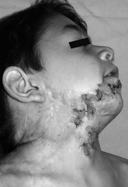 Fig. 4e Multi Z-plasty of residual scars.