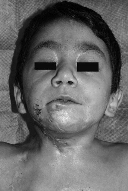 Fig. 4f Early operative result.