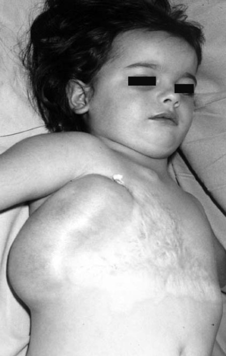 Fig. 5a Five-year-old year girl with implanted expander after burn.