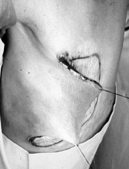 Fig. 5b Flap spreading stage.