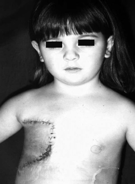 Fig. 5c Early operative result.