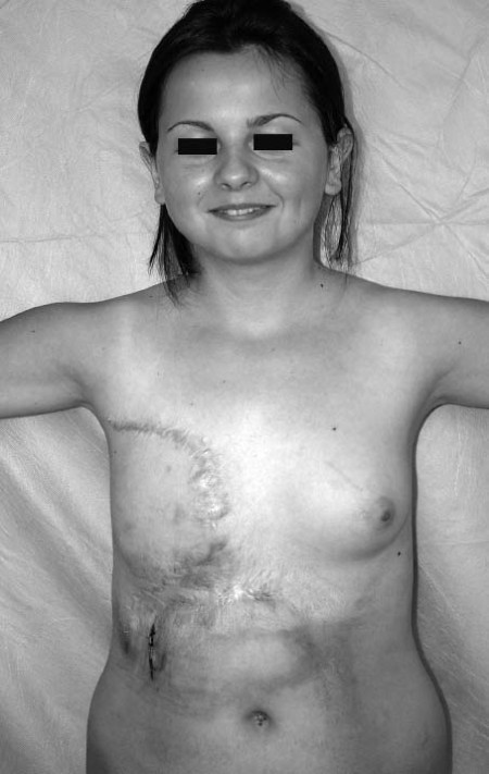 Fig. 5d Seven years later. Expander for reconstruction of residual scars.