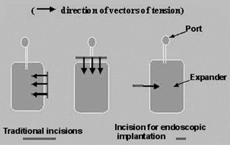 Fig. 2Scheme of orientation of tension vectors in relation to post-operative wounds in traditional and tissue expander implantation.