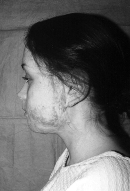 Fig. 5Patient N., 17 years old, with post-burn scar sequelae on left cheek and neck.