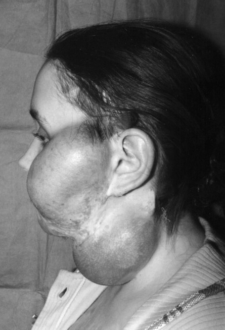 Fig. 6Two endoscopically implanted expanders and sufficient tissue gain achieved by intensive expansion in 27 days.