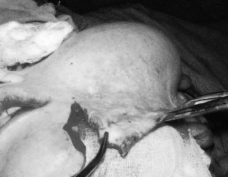 Fig. 8Mobilization of cutaneous or fasciocutaneous layer (under defect) towards expander pocket with subsequent haemostasis. Subdermal fat and if possible the superficial fascia is included in the flap in order to maintain blood supply to distal parts.