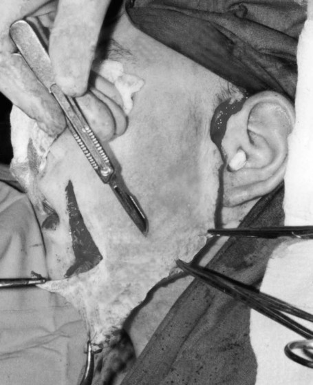 Fig. 9Expanded flap transferred to defect, final fitting performed, and tissues scheduled for removal excised from flap.