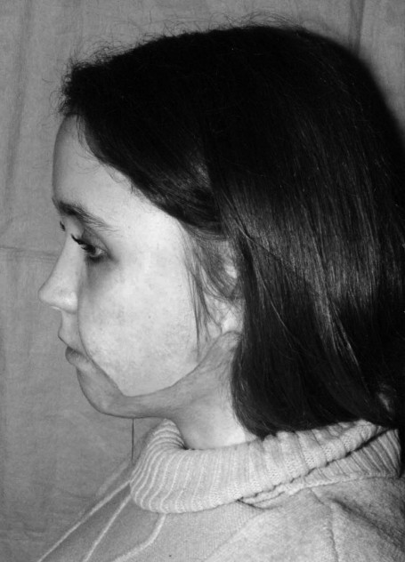 Fig. 10Same patient three months after reconstruction with expanded tissues.