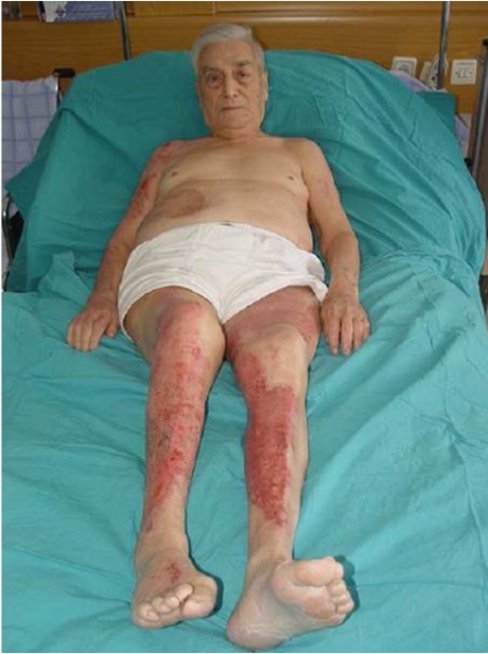 Fig. 4The patient on discharge.