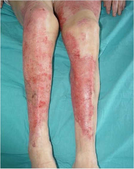 Fig. 5The patient on discharge.