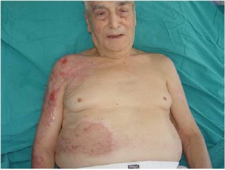 Fig. 6The patient on discharge.