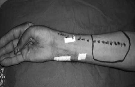 Fig. 2bCase 2, intra-op.