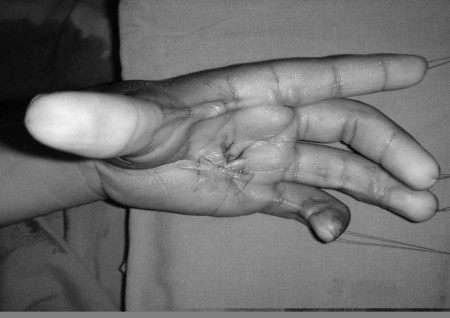 Fig. 3cCase 3, early post-op.