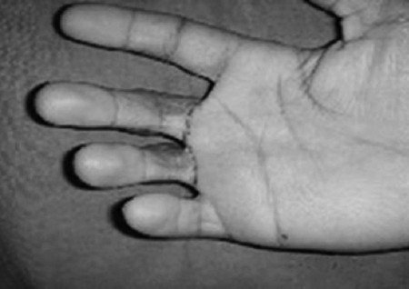Fig. 5aCase 5, pre-op 2.