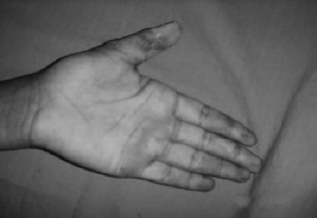 Fig. 7cCase 7, post-op 1.
