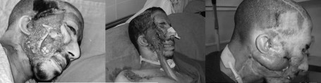 Fig. 2Patient victime d�une br�lure �lectrique par haut voltage avec point d�entr�e facial ayant entra�n� une mise a nu du maxillaire et de la mandibule. Parage et couverture par un lambeau deltopectoral et transfert du muscle temporal ont permi la couverture de la perte de substance.