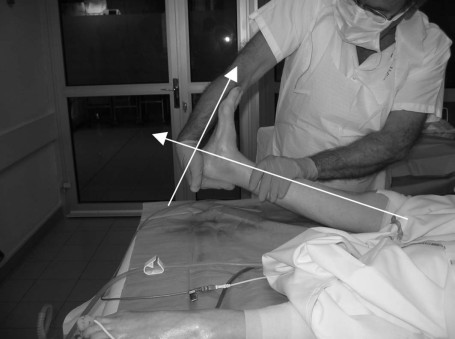 Fig. 2 Flexion dorsale droite de 4� � J60.
