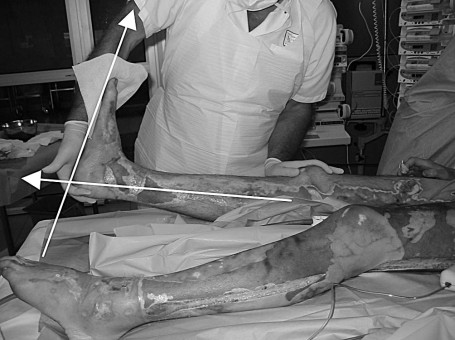 Fig. 3 Flexion dorsale droite de 18�.