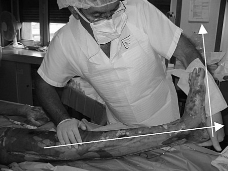 Fig. 4 Flexion dorsale gauche de 0�.