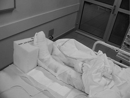 Fig. 5 Attelle anti-�quin et cale en mousse de d�rotation.