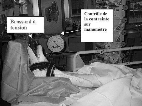 Fig. 7 Posture avec contrainte manom�trique: un brassard de prise de tension repli� est ins�r� entre l�avant-pied du patient et la semelle de l�attelle. Le brassard est ensuite gonfl� et exerce une pouss�e sur l�avant-pied; la force de contrainte est mesur�e et ajust�e par lecture sur l��cran.