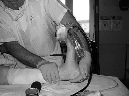 Fig. 8 Pied gauche: malposition cotation [1], la flexion dorsale est de 14� avec une contrainte de r�duction mesur�e avec le tensiom�tre (110 mm Hg).