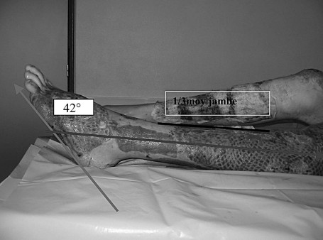 Fig. 10 Trac� des axes et mesure angulaire de l��quin.