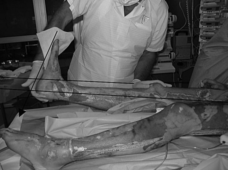 Fig. 11 Le segment jambier doit �tre suffisamment visible sur la photographie; l�axe jambier est parall�le � la cr�te tibiale dans son tiers moyen.
