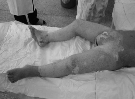 Fig. 2Deep partial-thickness wound in both lower extremities.