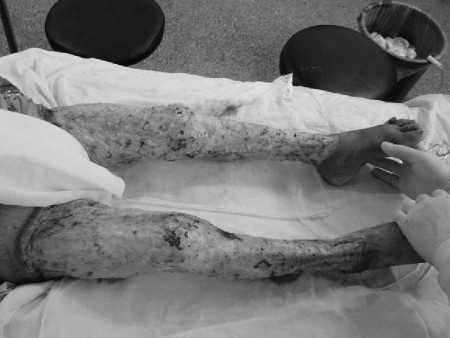 Fig. 3Wounds in both lower extremities excised to the extent of the fascia.